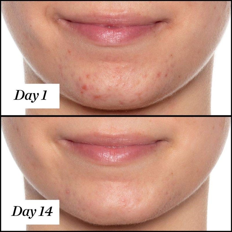 Sunday Riley U.F.O. Acne Treatment Face Oil - Salicylic Acid & Tea Tree Oil for Clear Skin