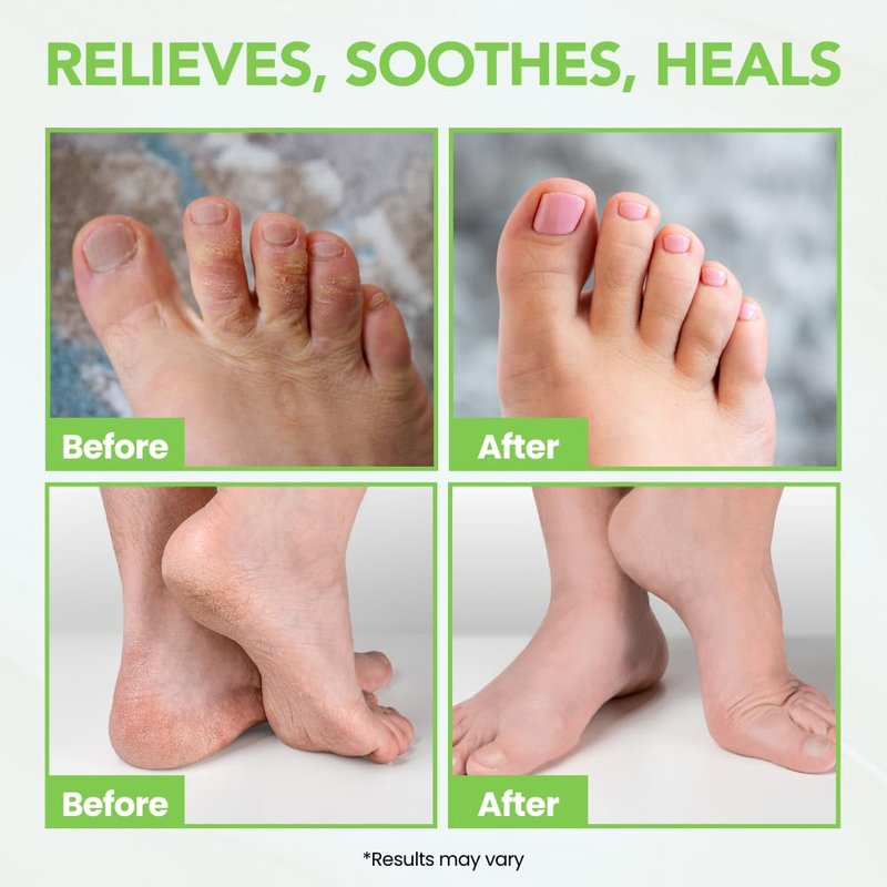 Thena Athletes Foot Cream Extra Strength Herbal Relief with Tea Tree Neem & Menthol, Athletes Foot Treatment Balm for Itchy Dry Cracked Feet, Heels and Toes, Advanced Plant-Based Foot Care