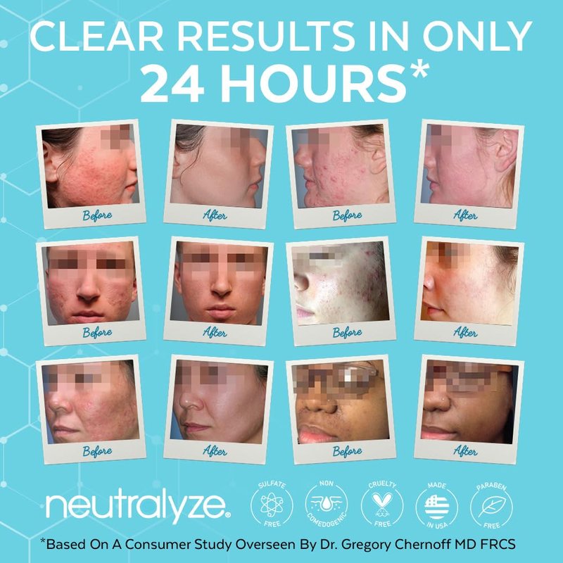 Neutralyze Moderate To Severe Acne Treatment Kit 2.0 (Clearing Serum & Synergyzer)