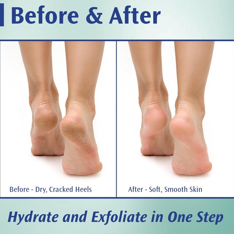 Pedifix 20% Urea Callus Control Foot Cream - Extra Strength Treatment for Dry, Cracked Feet | 4 Oz. (113g)