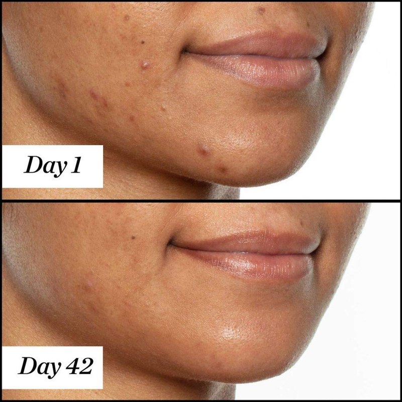 Sunday Riley U.F.O. Acne Treatment Face Oil - Salicylic Acid & Tea Tree Oil for Clear Skin