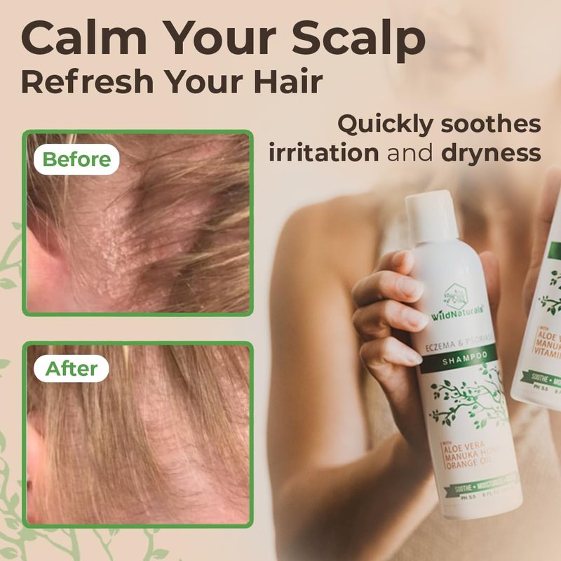 Wild Naturals Eczema & Psoriasis Shampoo – Anti-Dandruff Relief for Dry, Itchy Scalp – Hypoallergenic, Fragrance-Free Formula for Sensitive Scalp