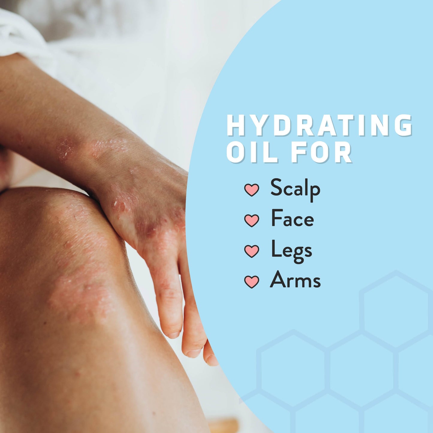 Psoriasis Honey Nourishing Scalp & Skin Serum - Dry Oil for Skin - Full Body Non Comedogenic Moisturizer Daily Dry Scalp Oil - Helps Psoriasis, Eczema, & More (1Oz)