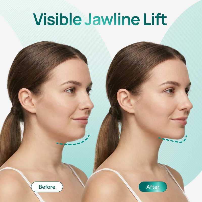 V-Line Chin Lifting Mask - Hydrogel Strap with Hyaluronic Acid & Aloe Vera for Jawline Shaping | 10 Pcs