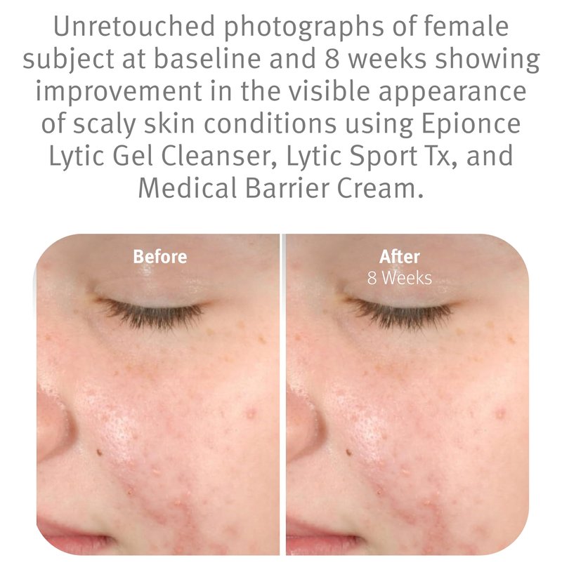 Epionce Lytic Gel Cleanser – Gentle Foaming Face Wash & Makeup Remover | For Oily, Combination & Problem Skin | Acne & Oil-Control Cleanser with Willow Bark | Dermatologist Skincare