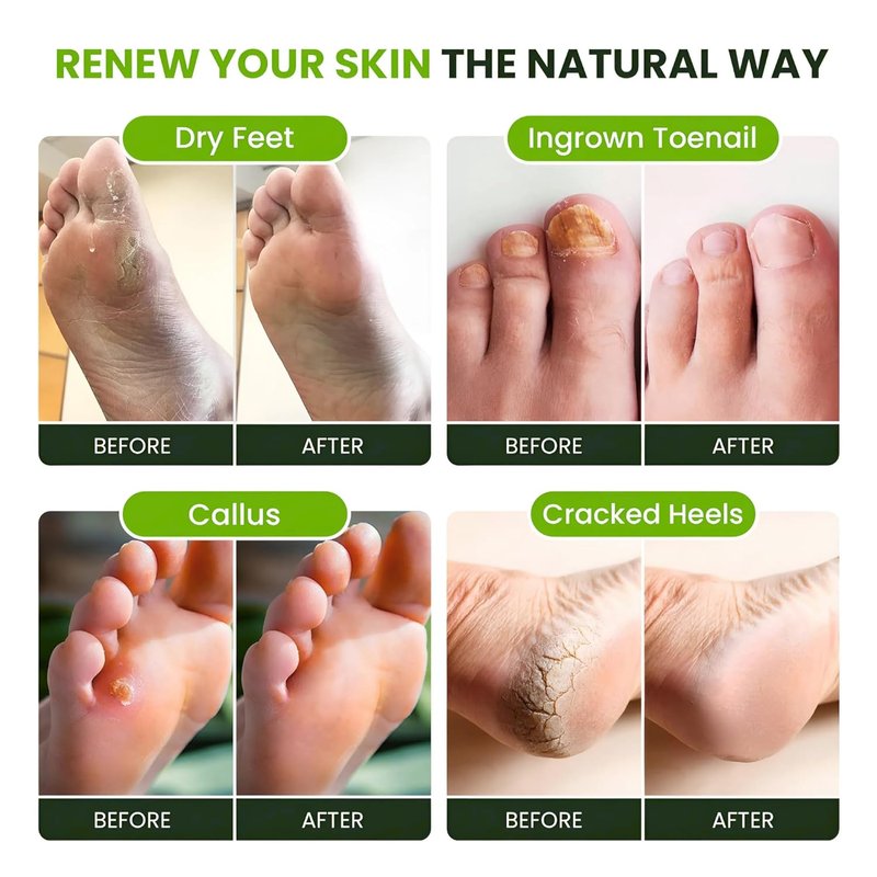 Tea Tree Oil Foot Soak with Epsom Salts - Relieve Pain, Soreness, Fungal Issues | Pack of 4