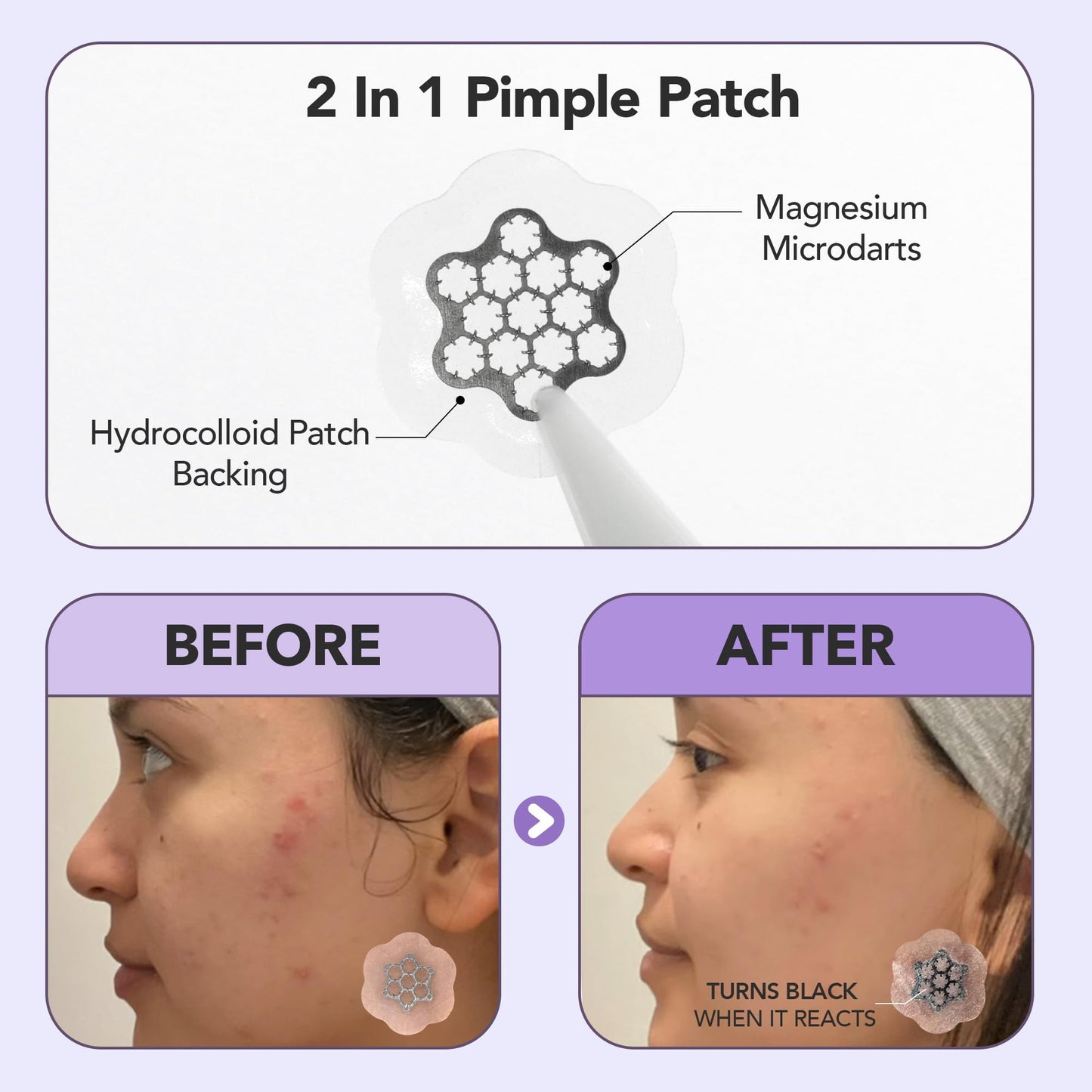 FreeGo Magnesium Blemish Microdarts Pimple Patch | Fast-Acting | Quick Calming | 99.9% Pure Magnesium | Madecassic Acid | Tea Tree | Eucalyptus Leaf | Hydrocolloid Spot Care Patch | Large | 6 Patches