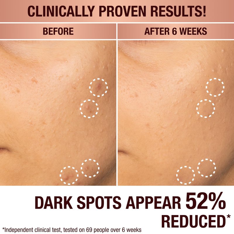 Charlotte Tilbury Radiance Recovery Dark Spot Serum - Tranexamic Acid & Vitamin C Serum for Brighter Looking Under Eyes, Redness, Uneven Skin Tone - Treatment to Reduce Appearance of Aging Skin (10ml)