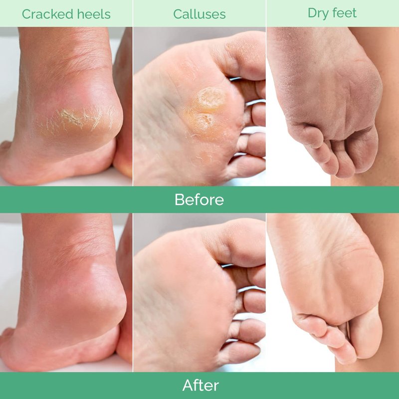 Foot Peeling Mask - Hydrating Treatment for Dry & Cracked Feet | 4 Pack