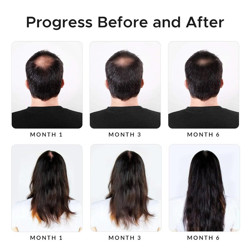 Minoxidil & Biotin Shampoo for Hair Growth - Caffeine, Castor Oil & Onion Infused | DHT Blocker for Thicker, Healthier Hair
