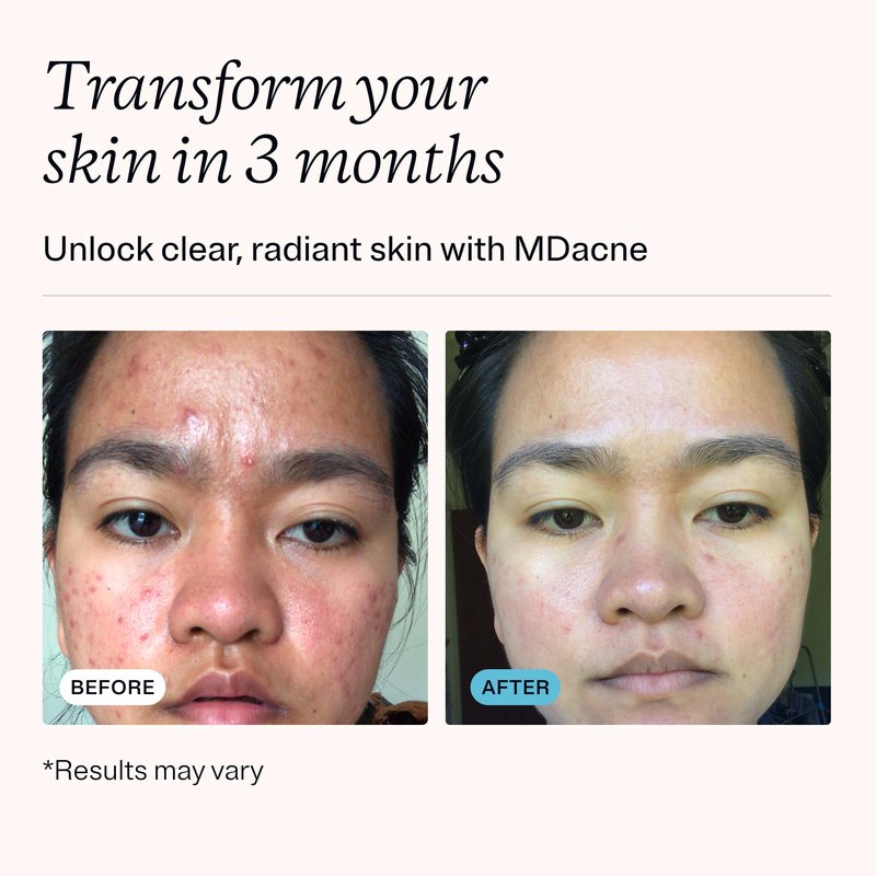 MDacne 3 Step Face Acne Treatment Kit, Benzoyl Peroxide Cream 2.5%, Salicylic Acid Cleanser, Niacinamide Moisturizer – Medicated Plant-Based Skincare for Adult & Teen Acne, 30 Day Kit