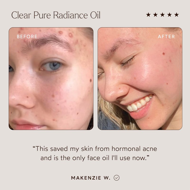 True Botanicals Clear Pure Radiance Oil | Oily Skin Types | Anti-Aging Face Oil for Acne Prone Skin | Treats Fine Lines & Wrinkles | Dermatologist Tested, All Natural, Vegan | 1 fl oz | 30 ml