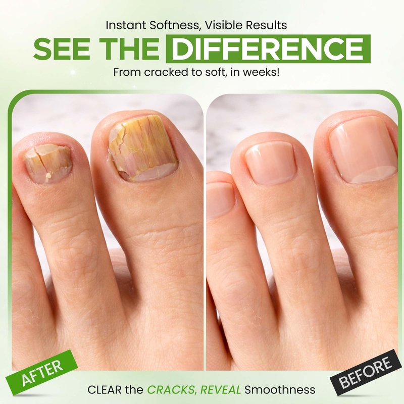 Urea Nail Gel - Softens Cracked Heel Calluses & Thick Toenails - Repairs Damaged, Yellow, Discolored Nails – Highly Effective & Quick-Dry Fingernails & Toenail Treatment (Urea 40%)