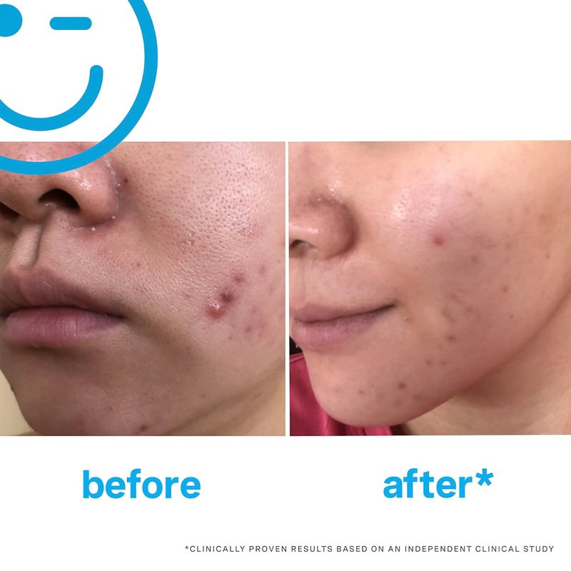 Kate Somerville Acne Treatment Set | EradiKate 3% Sulfur Cleanser & Mega-A Anti-Aging Serum | 4 oz & 1 oz