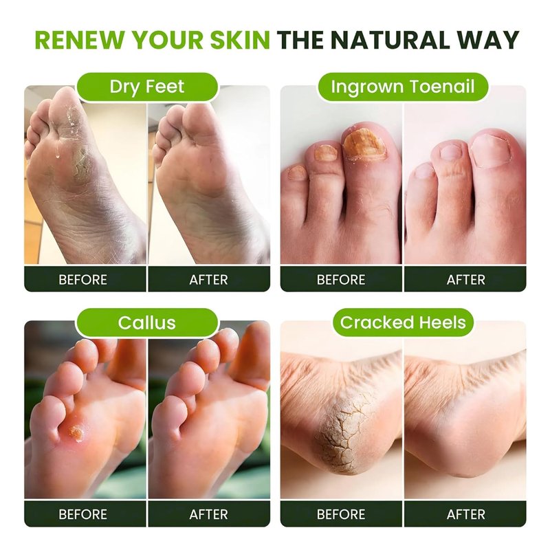 Tea Tree Oil Foot Soak with Epsom Salts - Relieve Pain, Soreness, Fungal Issues | Pack of 4