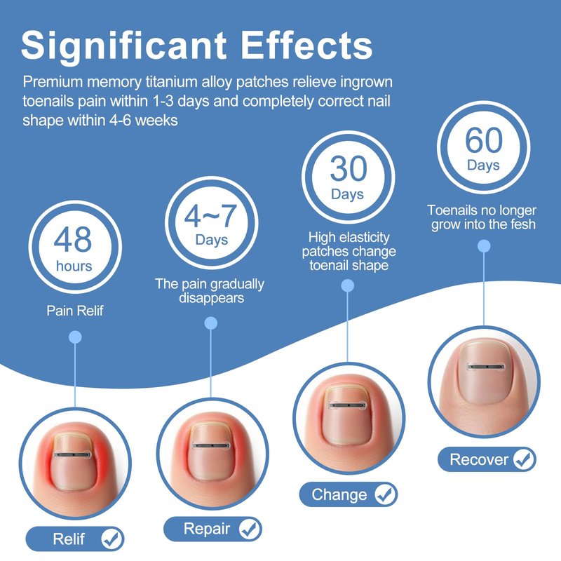 12Pcs Ingrown Toenail Corrector Strips for Curved Toenail Quick Relief,4 Multi-Sizes Ingrown Toenail Treatment Relief Tools Kit for Home Use