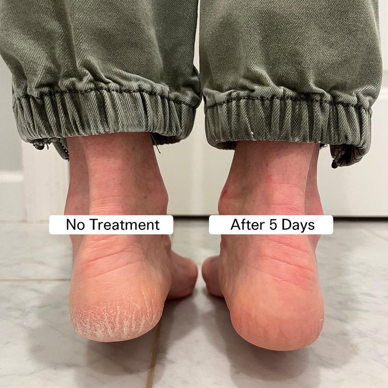 Pedestrian Project Cracked Heel Repair Foot Care Balm, Smooths & Fills Cracks & Rough Skin with Healing Shea & Mango Butters, Vegan, Cruelty Free, 1 oz