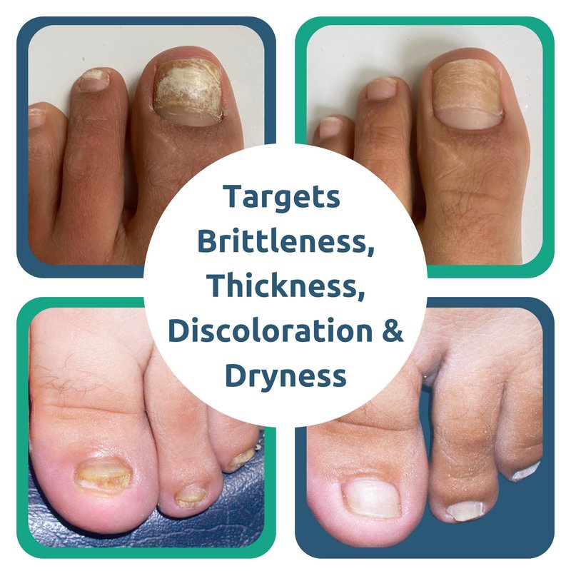 Nail Renewal Gel, Discoloration, Thickened Nails, Cracking, Brittle Nails, Fast 2-Day Results