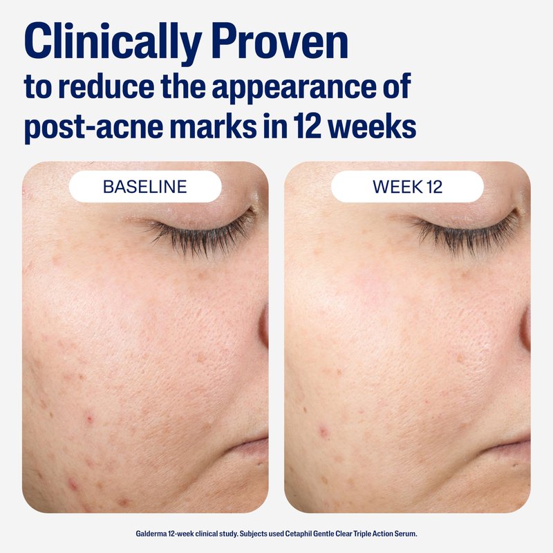 CETAPHIL Gentle Clear Repairing Post-Acne Serum, Retinol Alternative, Oil Free Serum for Sensitive Skin, 1 Fl Oz, Bakuchiol, Improves Skin Tone & Post-acne Marks, Dermatologist Recommended Brand