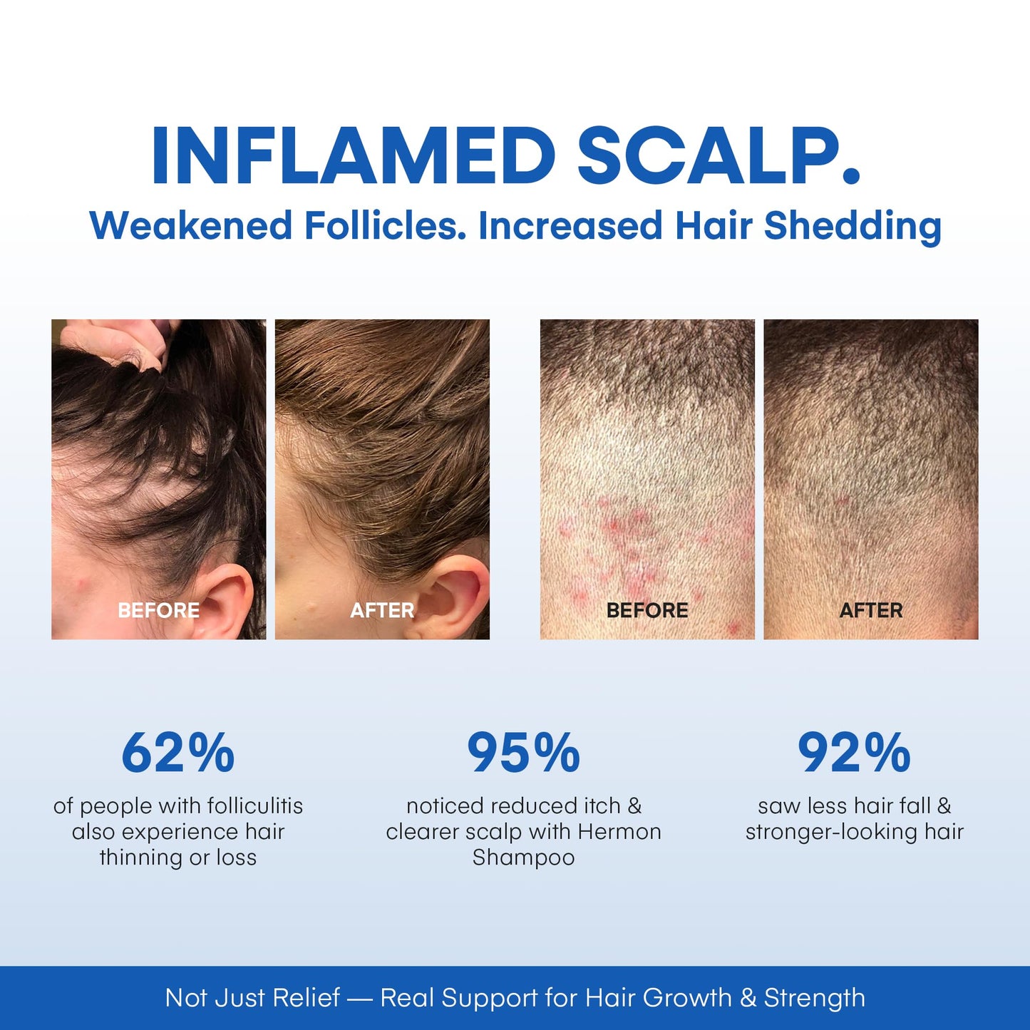 Hermon Folliculitis Shampoo for Itchy Scalp: Psoriasis, Dandruff & Seborrheic Dermatitis & Biotin – Soothes | Exfoliates | Reactivates Follicles