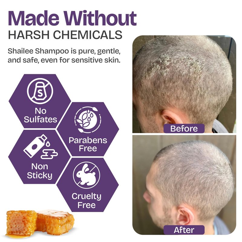 Psoriasis Shampoo with Scalp Scrubber for Eczema & Folliculitis Treatment - Seborrheic Dermatitis Antifungal Shampoo for Ringworm, Acne, Flaking, Dry & Itchy Scalp - Psoriasis Relief with Manuka Honey