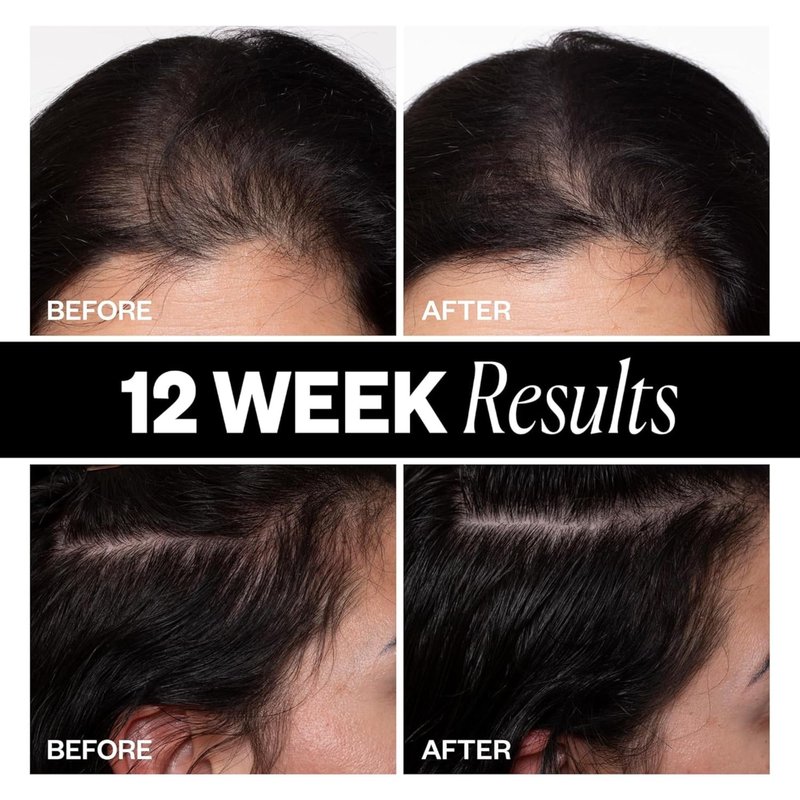 IGK SPONSORED Scalp Treatment for Hair Growth | Thickening Serum for Thinning Hair | Clinically Tested Mist for Hair Density and Volume | 2.1 Oz