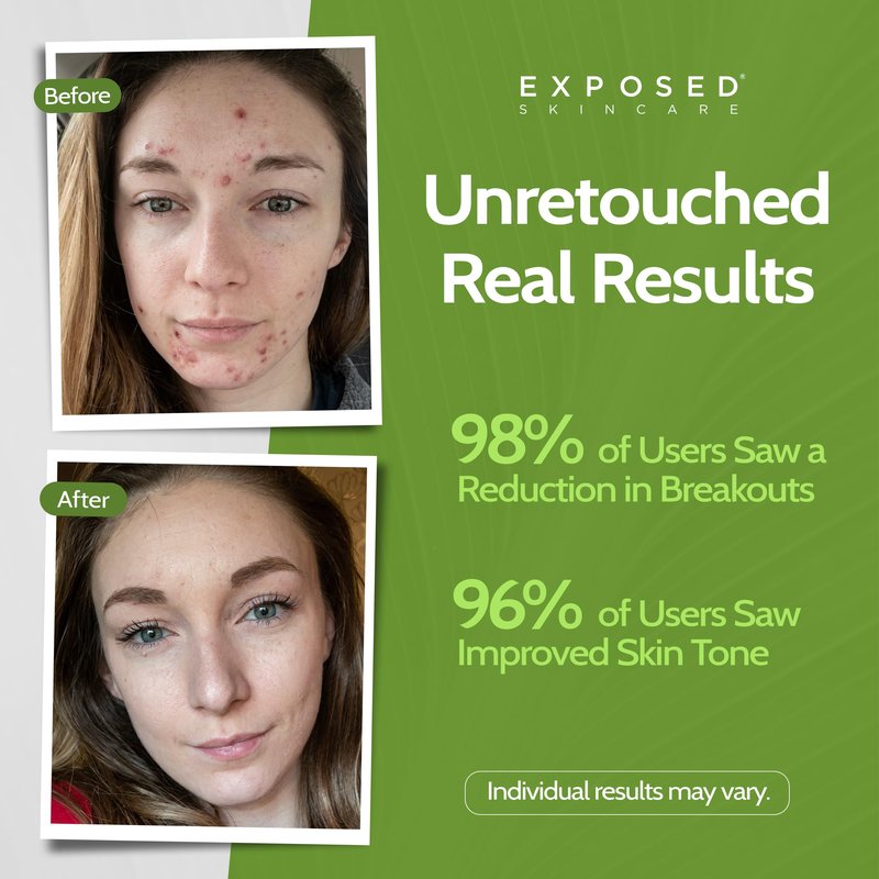 Exposed Skin Care, Clear Pore Serum with 1% Salicylic Acid for Sensitive and Oily Skin – Gently Clears Blackheads, Minimizes Pores and Reduces Excess Oil – Natural, Non-toxic and Cruelty Free