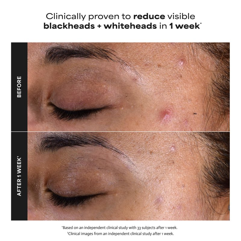 Paula's Choice SKIN PERFECTING 2% BHA Liquid Exfoliant with Salicylic Acid, Facial Polish for Pores, Wrinkles & Fine Lines, Suitable for Blackhead-Prone Skin, Fragrance-Free (5 Fl Oz (Pack of 2))