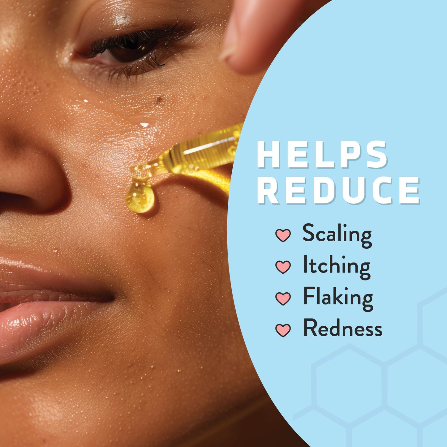 Psoriasis Honey Nourishing Scalp & Skin Serum - Dry Oil for Skin - Full Body Non Comedogenic Moisturizer Daily Dry Scalp Oil - Helps Psoriasis, Eczema, & More (1Oz)
