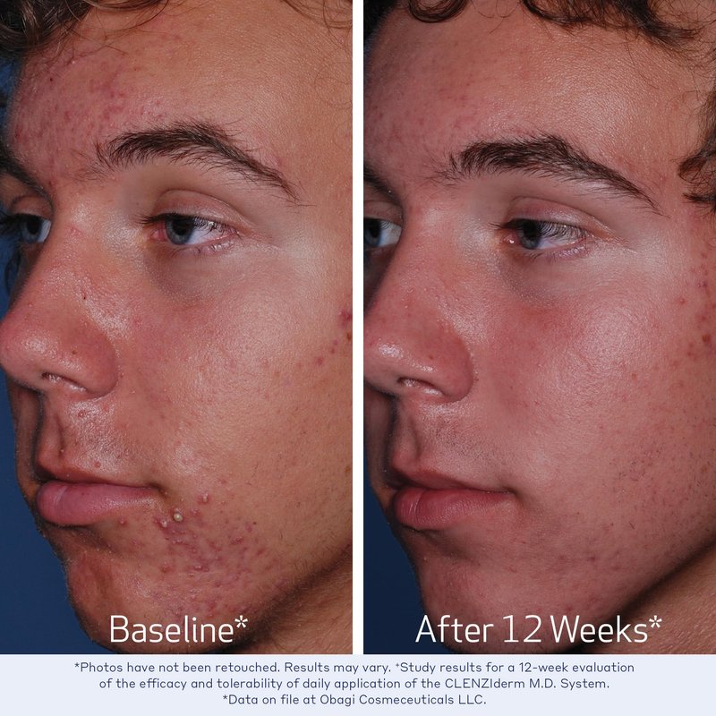 Obagi CLENZIderm M.D. Therapeutic System – 3 Step Acne Treatment System Includes 2% Salicylic Acid (BHA) Cleanser, 2% Salicylic Acid (BHA) Exfoliating Toner, 5% Benzoyl Peroxide (BPO) Acne Treatment