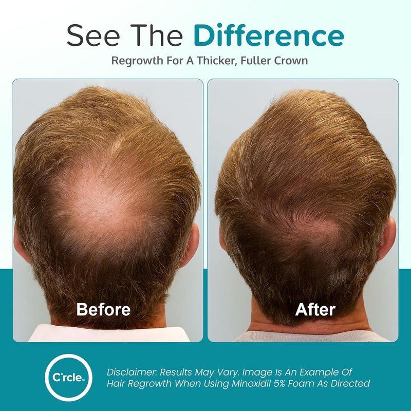 Minoxidil Foam for Men - 5% Extra Strength Hair Regrowth Treatment | Unscented 3-Month Supply