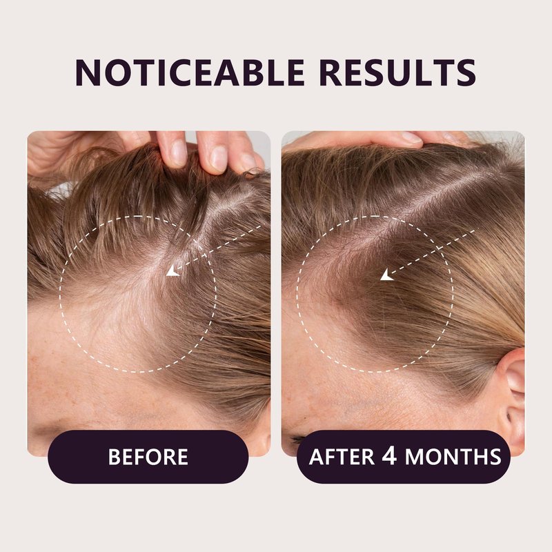 5% Minoxidil Hair Growth Serum for Women: Extra Strength Hair Loss Treatment with Biotin for Thinning Hair - Regrowth Topical Solution - 3 Month Supply