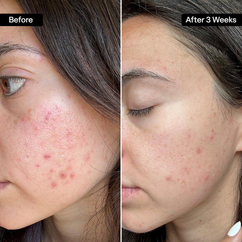 QRxLabs Salicylic & Glycolic Acid Acne Clearing Pads - 2% Salicylic & 10% Glycolic Acid - Exfoliating Pads for Acne, Bacne, Butt Acne, Body Acne - Daily Pads - 50ct